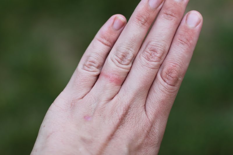 Red Itchy Bumps On Hands Dog Breeds Picture