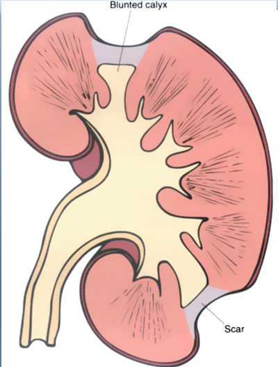 Гидронефроз правой почки 1-2 степени. Полное удвоение члс почки. Деформация почки на узи. Деформация почки что это. Деформация почки что это.
