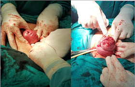 Myomectomy- for uterine fibroid- done by Dr Alaa Mosbah