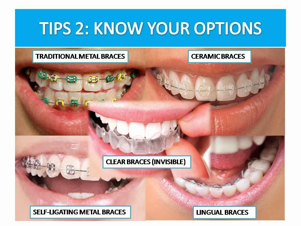 Ask.DentistMY 牙牙学医 [MUST READ] 6 Tips To Prepare For Braces