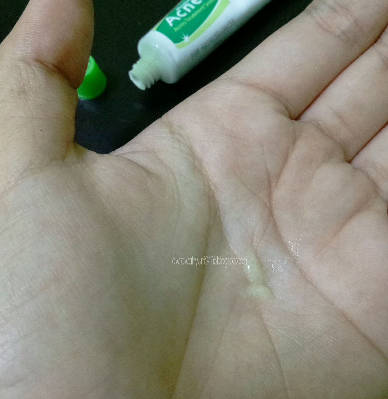 REVIEW Acnes Starter Pack Treatment Series Gadis Kacang Bali