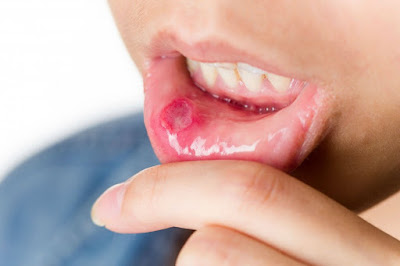 A Painful Mouth Ulcer