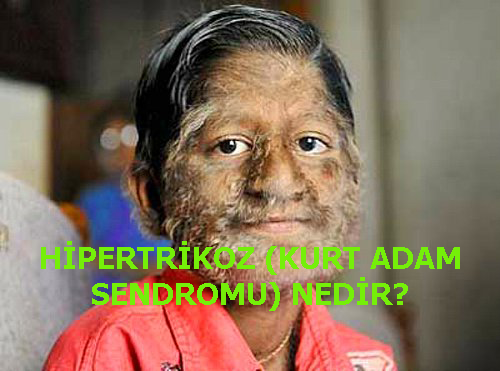HİPERTRİKOZ (KURT ADAM SENDROMU) NEDİR?