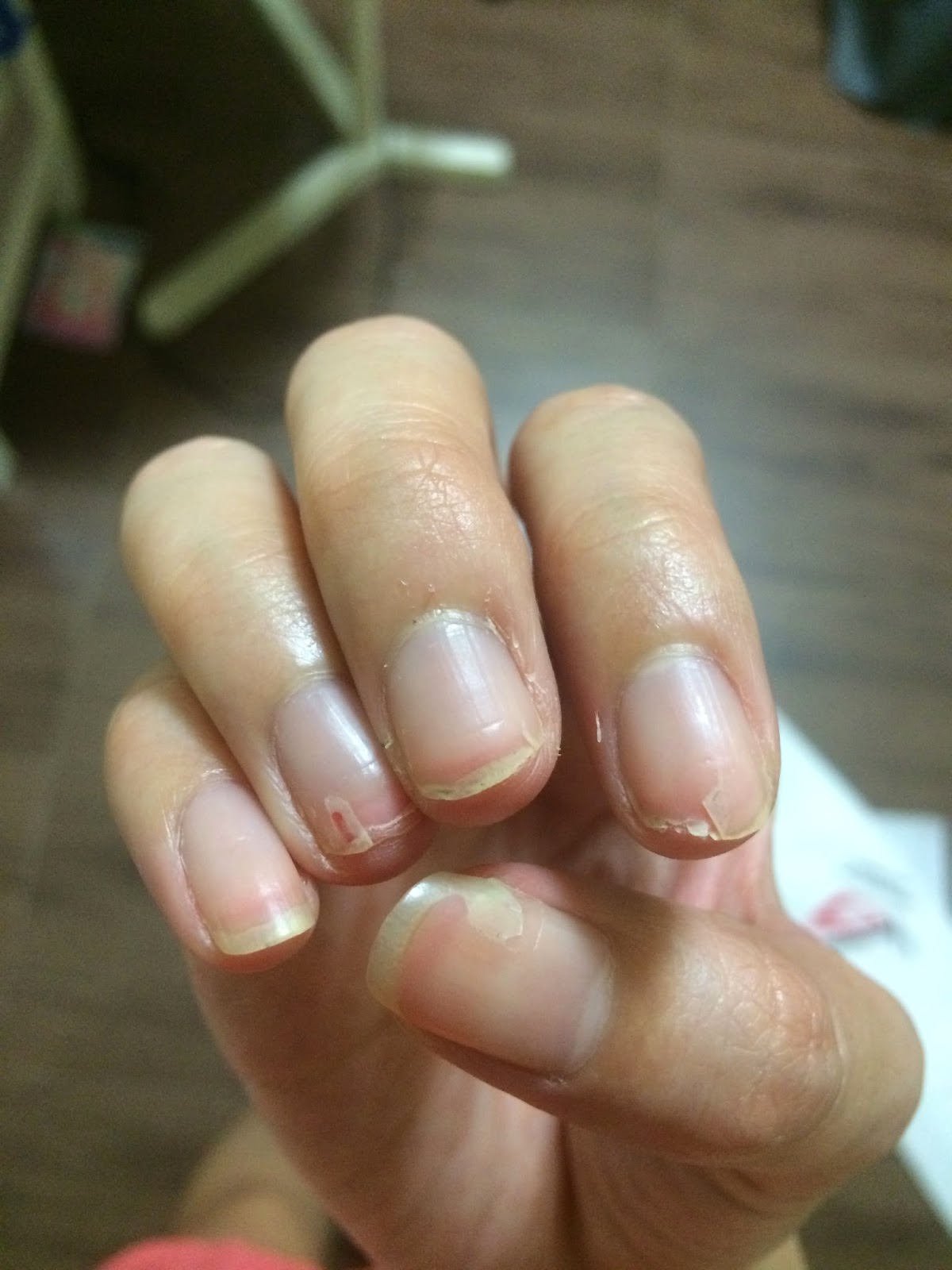 The Dettol Diaries Peeling Fingernails after HFMD