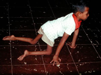 penyakit polio dan jenisnya | healty inside