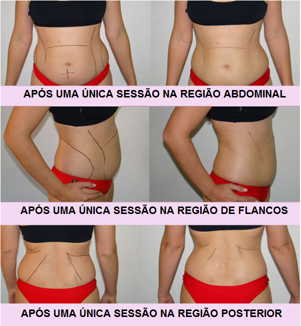 D&rsquo; Lucy Estética!!!: Lipocavitação - Lipo sem cururgia!