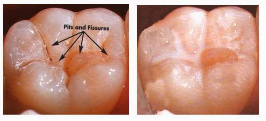 Apa Itu Pit Fissure Sealants apa-itu-pit-fissure-sealants