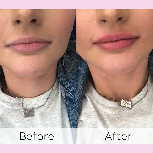 What's It Like Getting Lip Filler? | Subtle Lip Enhancements at White Swan Aesthetics* | Lovelaughslipstick Blog