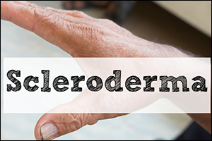 how can scleroderma be treated