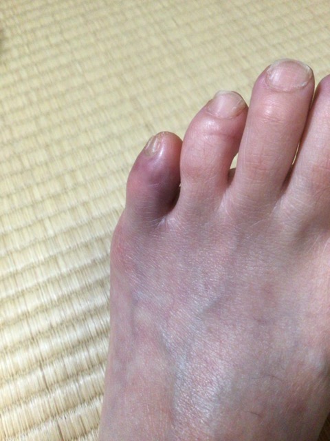 足 の 指 骨折 症状