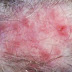 Skin Cancer On Scalp