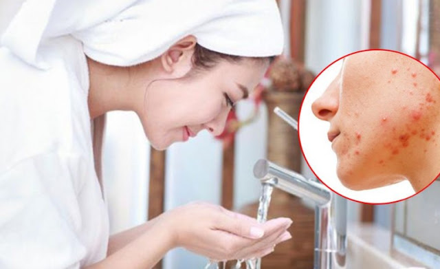 Cara Menghilangkan Jerawat Batu yang Membandel dan Pencegahannya