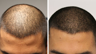 hair transplant results at face value clinic