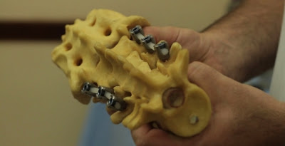 Medicos Argentinos crean Prótesis flexibles de columna vertebral al alcance de todos