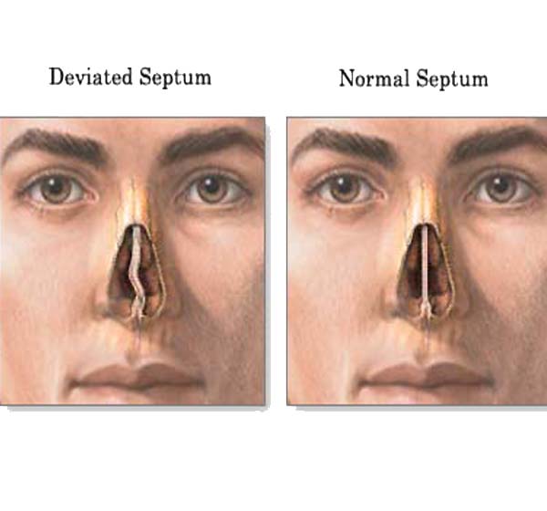 Recovering From Septoplasty And Turbinate Reduction Surgery Diagnosing