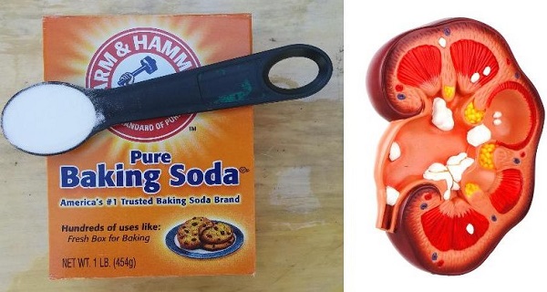 MEDIANTE EL USO DE 1 CUCHARADITA DE BICARBONATO DE SODIO USTED PUEDE REPARAR SU RIÑÓN DAÑADO NATURALMENTE! MEDIANTE EL USO DE 1 CUCHARADITA DE BICARBONATO DE SODIO USTED PUEDE REPARAR SU RIÑÓN DAÑADO NATURALMENTE!