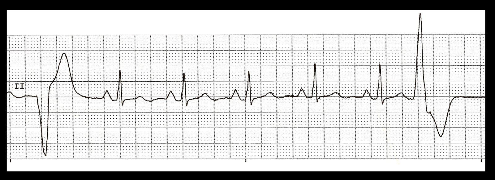 Basic EKG Rhythm Test 17