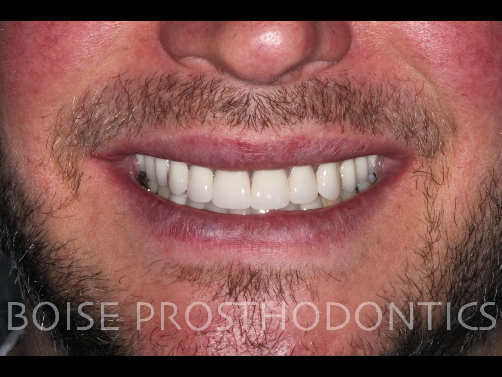 Boise Idaho Prosthodontics: True Immediate Maxillary Complete Denture ...