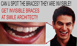 Invisible Braces