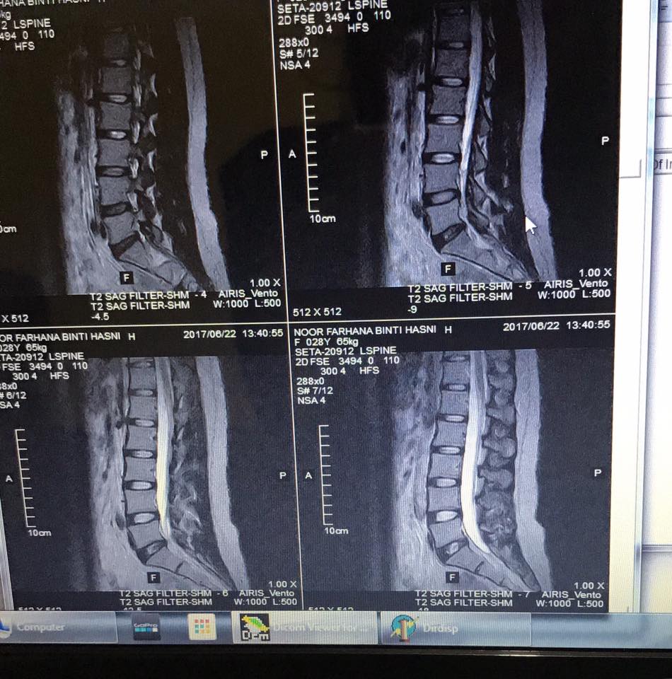 Rasa Kebas Kaki, Sakit Belakang Doktor Kata Angin, RupaRupanya Slipped