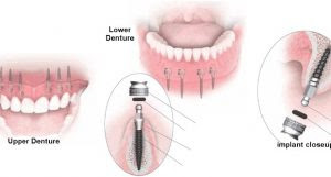 Cấy ghép răng Implant có gây hại cho cơ thể không?