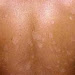 Best Natural Tips to Treat White Patches on Skin