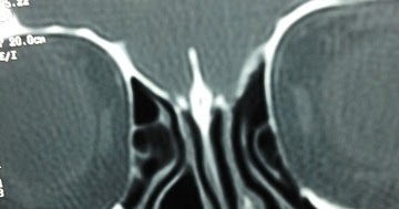 ENT Surgeon's blog: Giant Concha bullosa