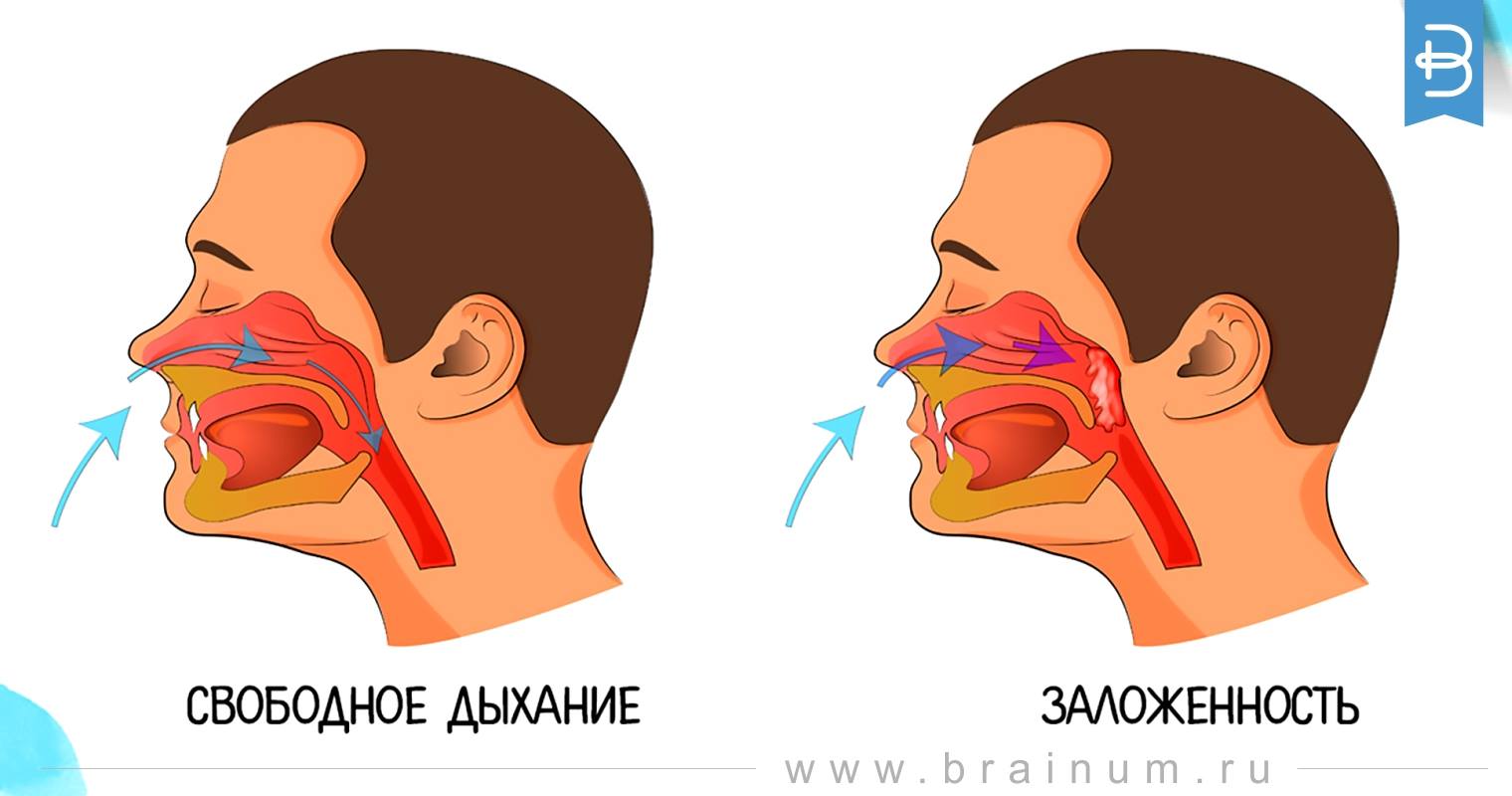 Заложенность носа без соплей у взрослого