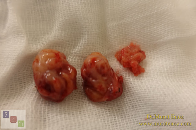 Bademcik Ameliyatı ve Geniz Eti Ameliyatı Kimler İçin Gereklidir?