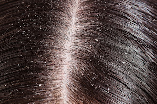 Dandruff-and-dry-scalp-are-different-but-need-similar-treatment