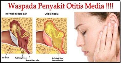 Definisi Penyebab Dan Pengobatan Serta Gejala Klinis Otitis Media