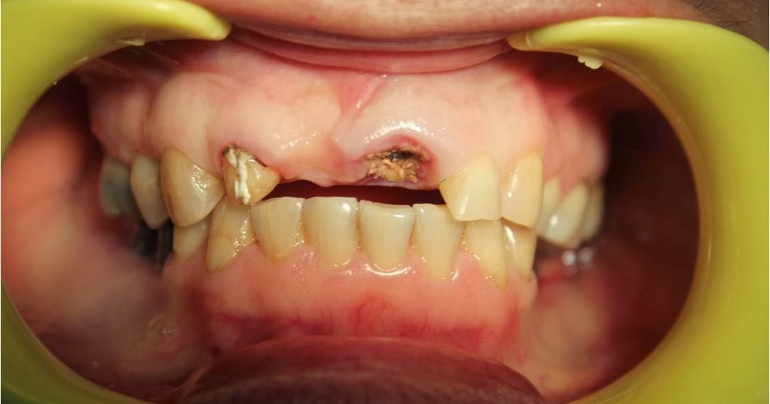 Failed root canal treatment options USING DENTAL IMPLANTS