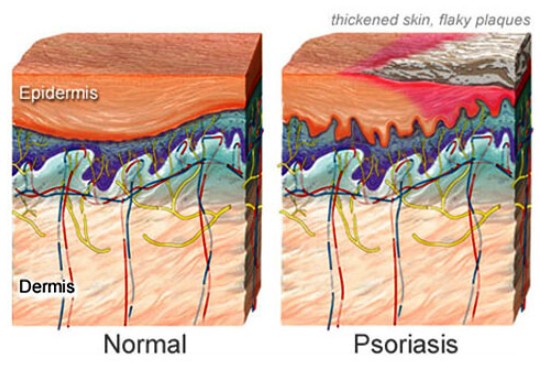 What Is Psoriasis