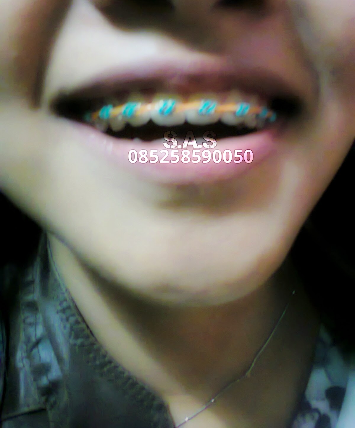 Koleksi Foto Senyum Behel Cantik dan Model Warna Karet