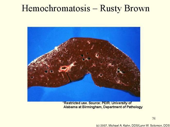 Гемохроматоз симптомы