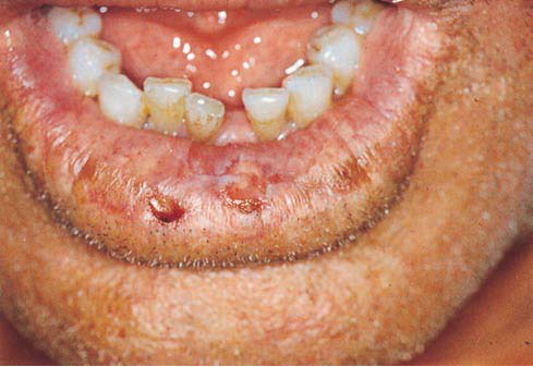 A GUIDE TO COMMON ORAL LESIONS - UMKC School of