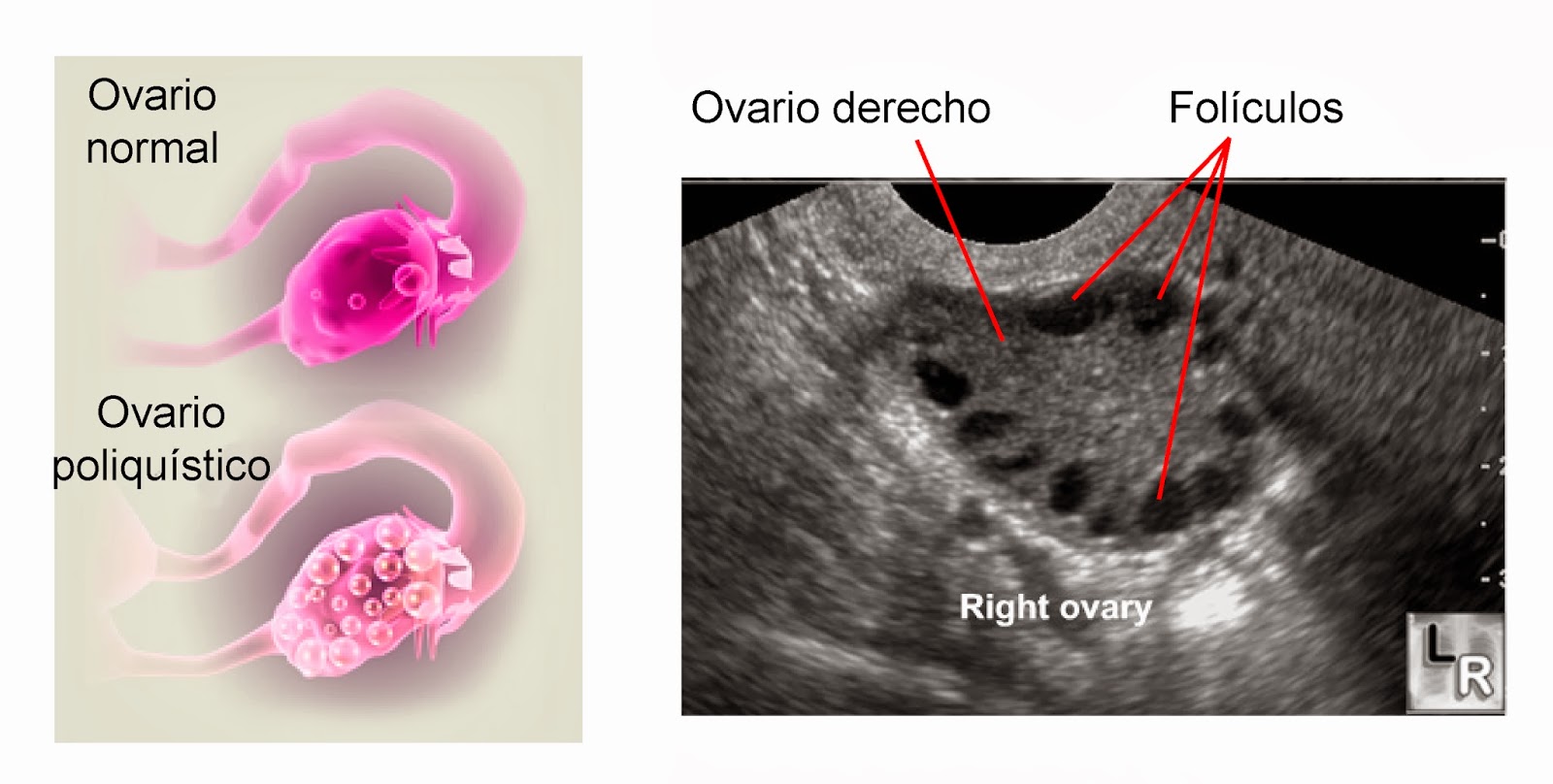 Testosterona en ovario poliquistico