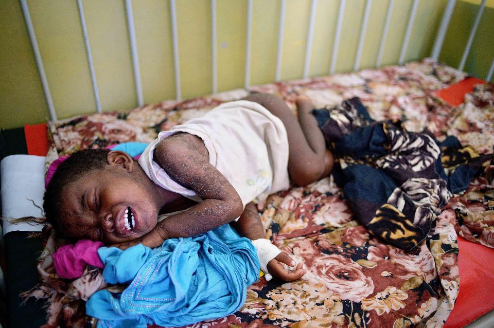 Image result for Measles in SOmalia