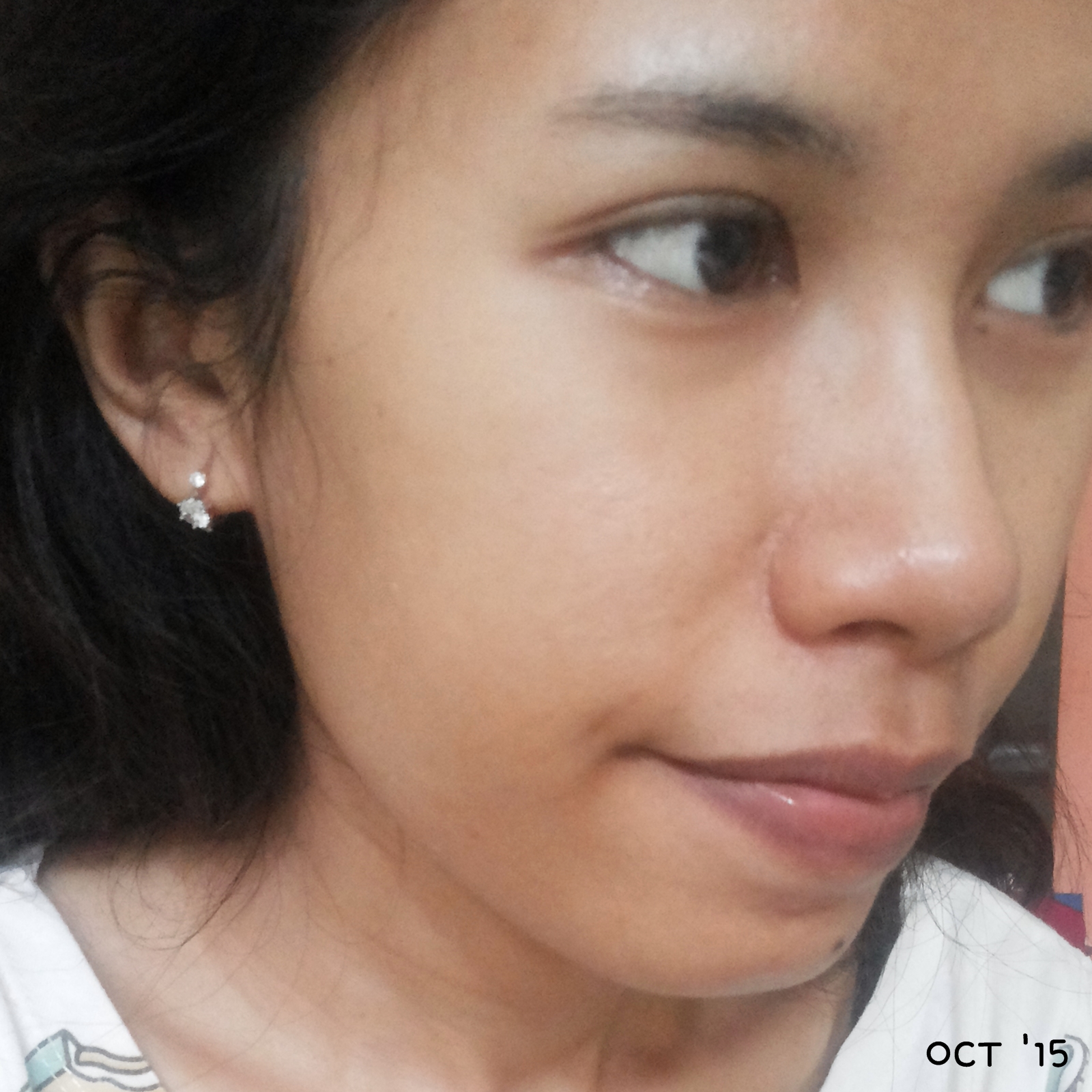 39+ Acne Fighter Adalah
 Pics