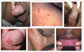 Apa Obat Buat Penyakit Sipilis Kronis