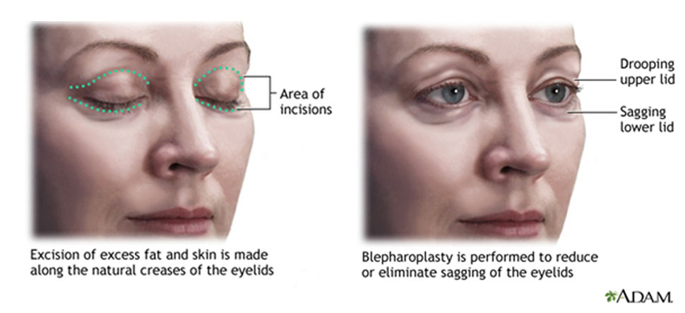 HOW DO I CHOOSE A PLASTIC SURGEON FOR EYELID SURGERY?