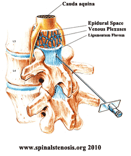 epidural site pain years later epidural site pain years later