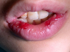 lip diseases