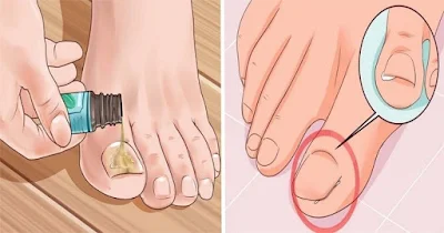 How to Effectively Remove a Painful Ingrown Toenail WITHOUT Having To Go To The Doctor planet-today.com