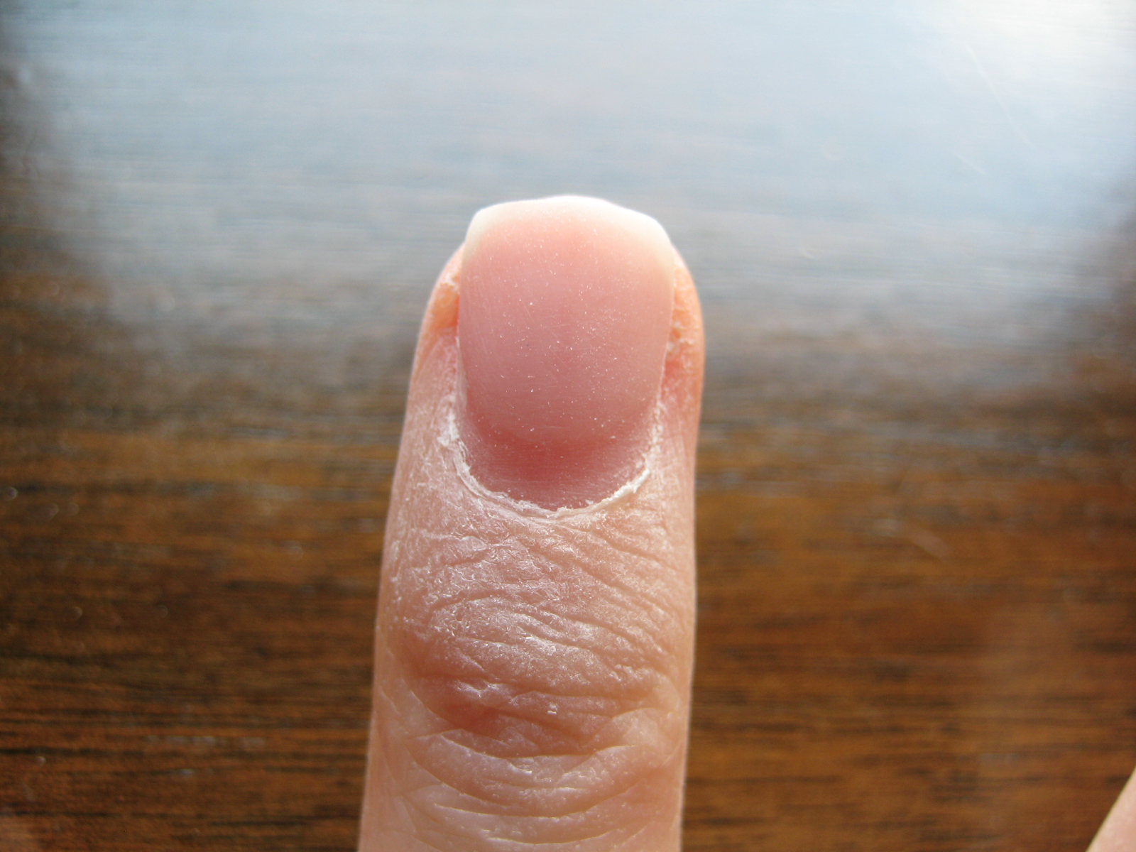 hogyan gyógyítsuk meg a körömfajt egy nagy ujjal