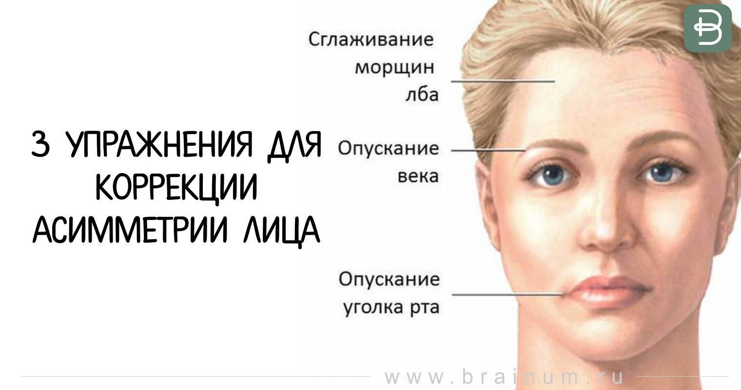 Правый лицевой нерв. Нейропатии лицевого нерва. Паралич тройничного нерва лица. Лицевой неврит.