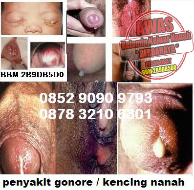 Gejala Gonorrhea Atau Kencing Nanah Gejala Gonorrhea Atau Kencing Nanah
