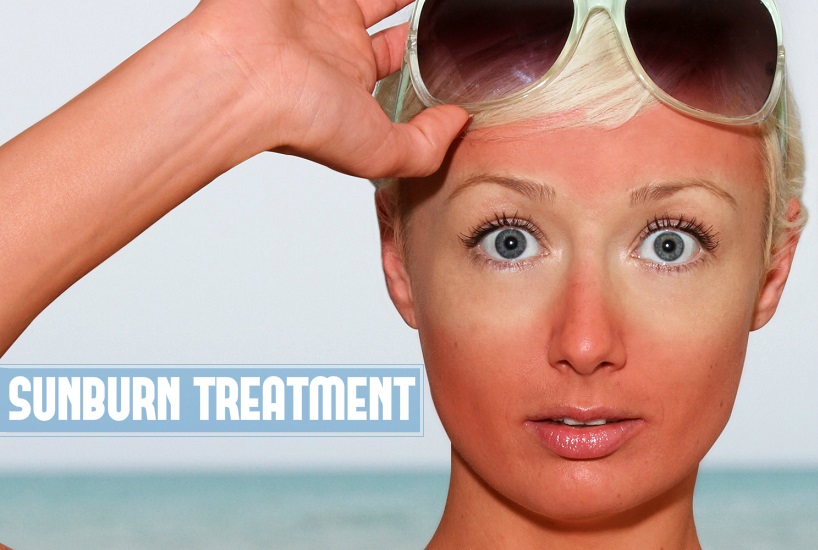 10 Home Remedies For Sunburn Treatment