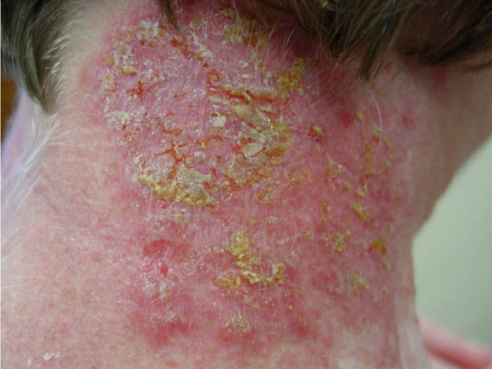 Consultations in Dermatology The Groin Cracks Hailey Hailey Disease