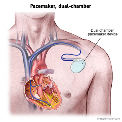 pacemakers pacemaker heart cardiac arrhythmia surgery leads two september
